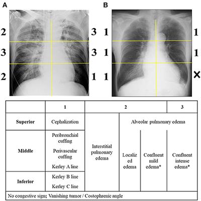 A Combination of Chest Radiography and Estimated Plasma Volume May Predict In-Hospital Mortality in Acute Heart Failure